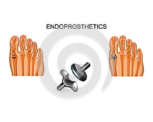 Big toe joint replacement