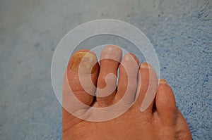 Big toe toenail fungus with all toes