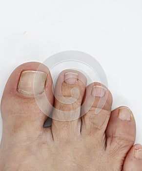 big toenail of a person suffering from onychomycosis, a fungal infection that causes yellowing of the nail