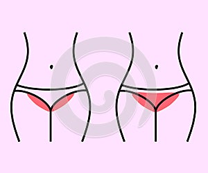 Bikini area. Removing unwanted body hair. Silhouette of a woman. Vector