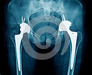 Bilateral hip replacement