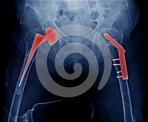 Bilateral hip replacement