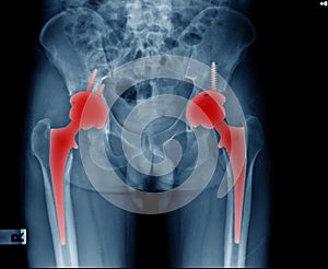 bilateral hip replacement of patient, hight qulity x-ray image o