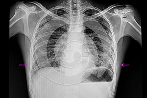 bilateral lower lungs pneumonia