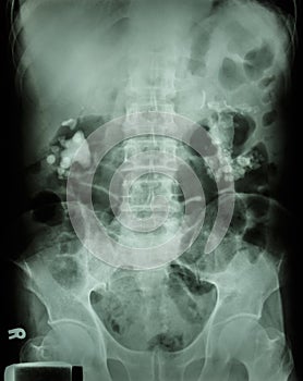 Bilateral renal calculi (staghorn)