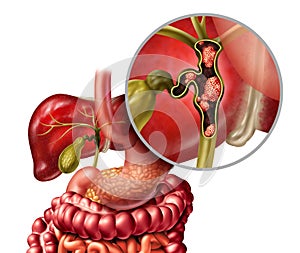 Bile Duct Cancer