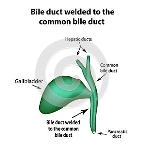 Bile duct welded to the common bile duct. Pathology of the gallbladder. Cholecystitis.