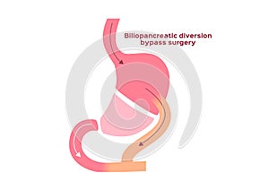 Biliopancreatic diversion bypass surgery