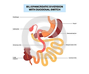 Biliopancreatic diversion procedure