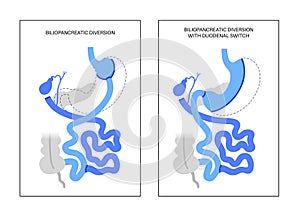 Biliopancreatic diversion procedure