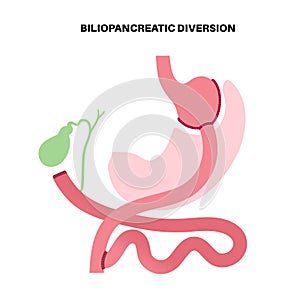 Biliopancreatic diversion procedure