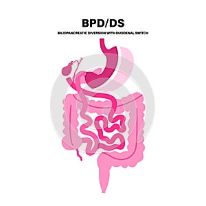 Biliopancreatic diversion procedure