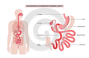 Biliopancreatic diversion procedure