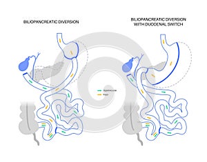 Biliopancreatic diversion procedure