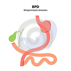 Biliopancreatic diversion procedure