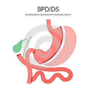 Biliopancreatic diversion procedure