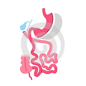 Biliopancreatic diversion procedure