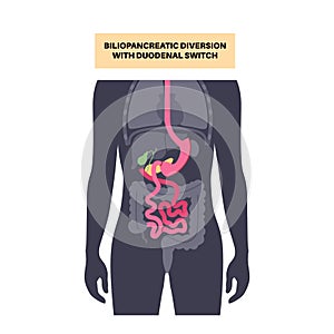 Biliopancreatic diversion procedure