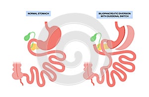 Biliopancreatic diversion procedure