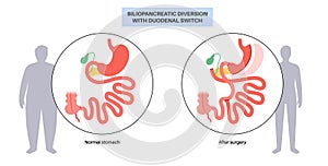 Biliopancreatic diversion procedure