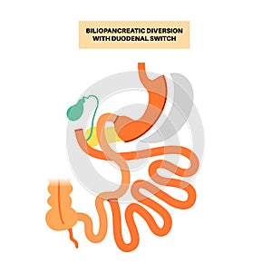 Biliopancreatic diversion procedure