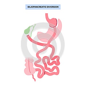 Biliopancreatic diversion procedure