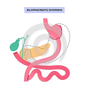 Biliopancreatic diversion procedure