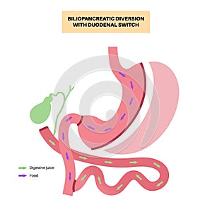 Biliopancreatic diversion procedure