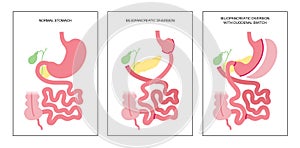 Biliopancreatic diversion procedure