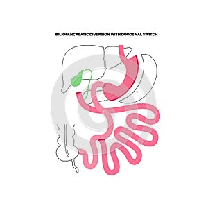 Biliopancreatic diversion procedure