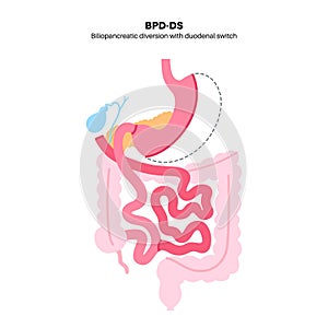 Biliopancreatic diversion procedure