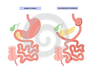 Biliopancreatic diversion procedure