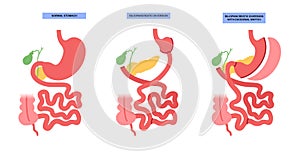 Biliopancreatic diversion procedure