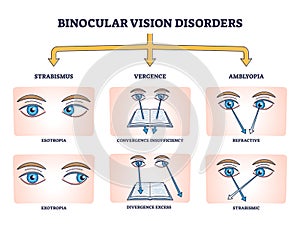 Binocular vision disorders with all eye defect examples outline diagram photo