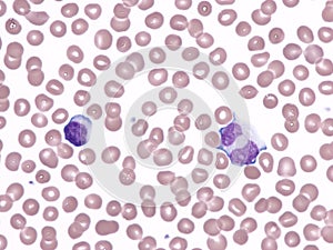 Binucleated lymphocyte in peripheral blood (Natalizumab).