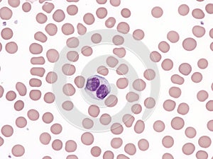 Binucleated lymphocyte in peripheral blood (Natalizumab).