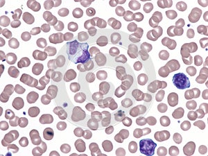 Binucleated lymphocyte in peripheral blood (Natalizumab).
