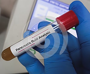 Biochemist or medical technologist hold Pancreatic cyst fluid analysis sample, Ascites