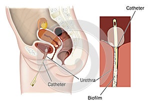 Biofilm formation on catheter