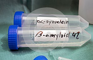 Biomarkers in Cerebrospinal Fluid Discriminate Between Dementias, Combining biomarkers from cerebrospinal fluid is helping