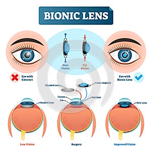 Bionic lens vector illustration. Eye lens structure labeled scheme. photo