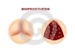 Bioprosthesis and an aortic valve replacement vector