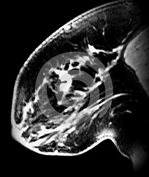 Biopsy clip on irregular mass in breast