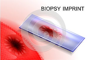 Biopsy imprint.diagnosis of cancer photo