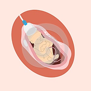 Birth baby Vacuum medical process