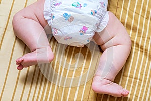 Birthmark on Asian baby girl legs
