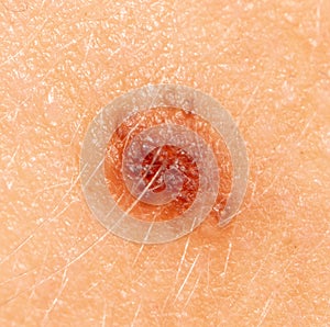 Birthmark on human skin