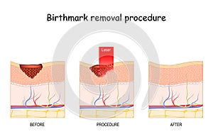 Birthmark laser Removal photo