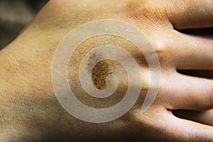 Birthmark or mole on the skin of the hand. Can be used for the concept of removing birthmarks