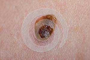 Birthmark or papilloma or Keratopapilloma on human skin closeup